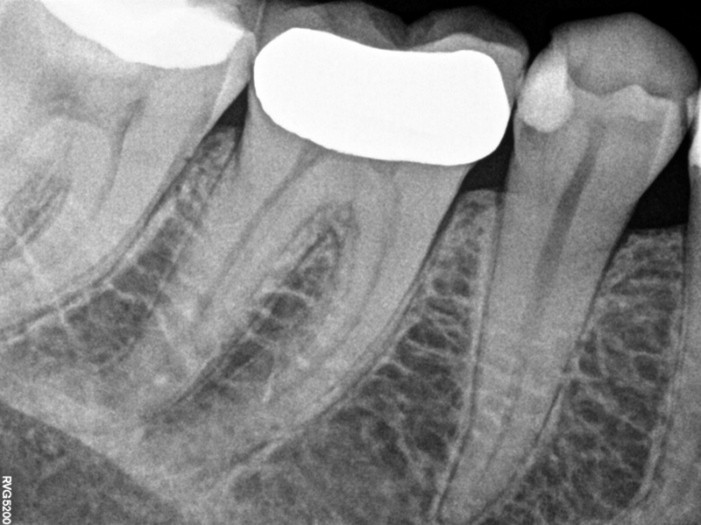 Molar endodontics - Pre-op case 1